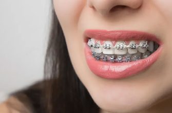 брекети у Львові