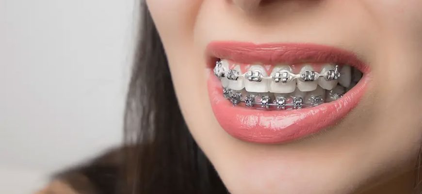 брекети у Львові